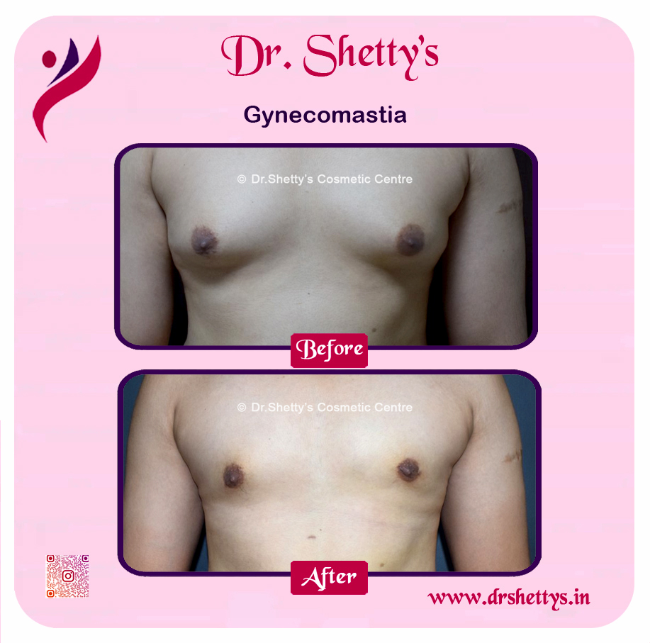 Gynecomastia Surgery Male Breast Reduction 30