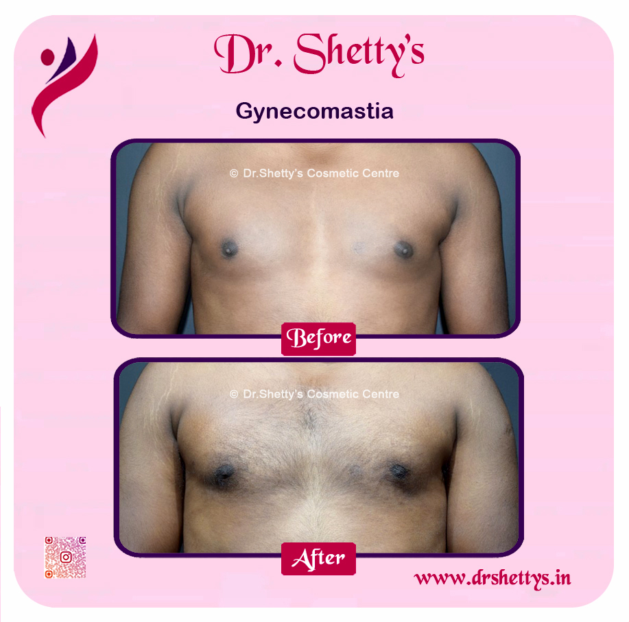 Gynecomastia Surgery Male Breast Reduction 31