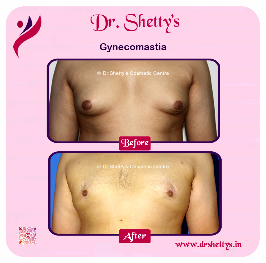 Gynecomastia Surgery Male Breast Reduction 33