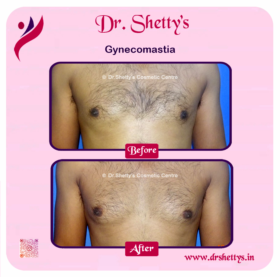 Gynecomastia Surgery Male Breast Reduction 34