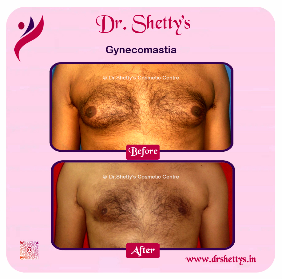 Gynecomastia Surgery Male Breast Reduction 35