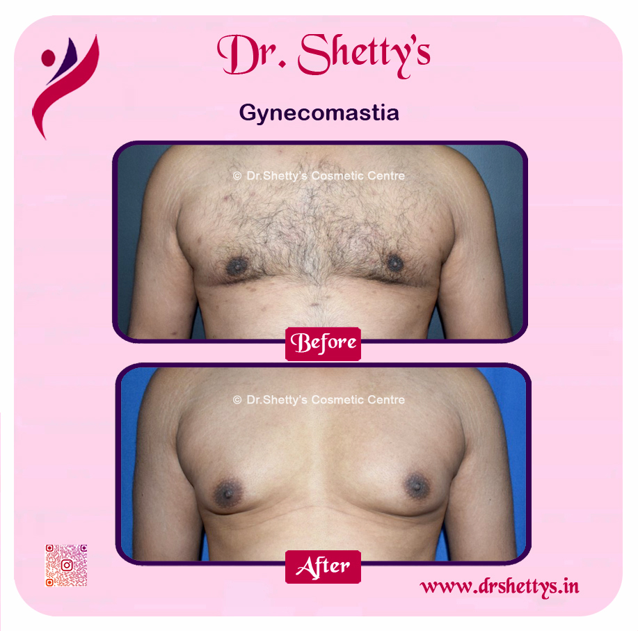 Gynecomastia Surgery Male Breast Reduction 37