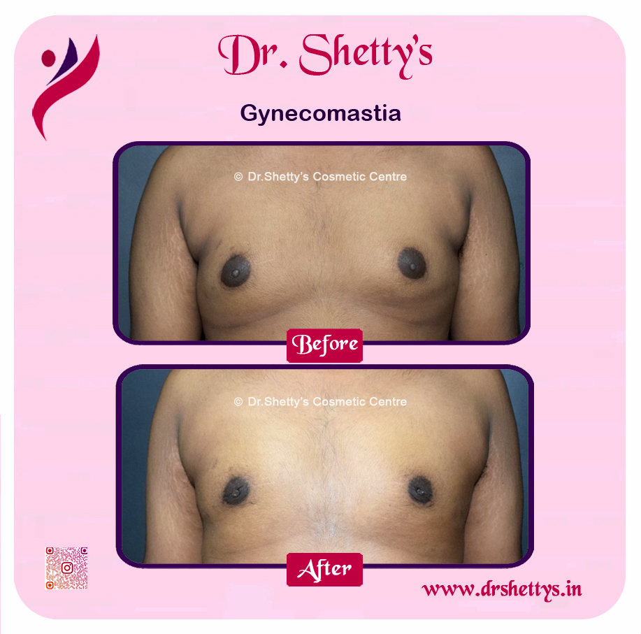 Gynecomastia Surgery Male Breast Reduction 38