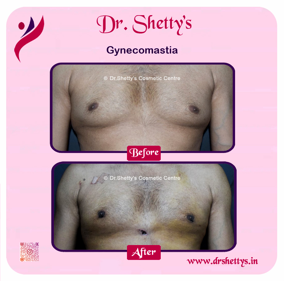 Gynecomastia Surgery Male Breast Reduction 40