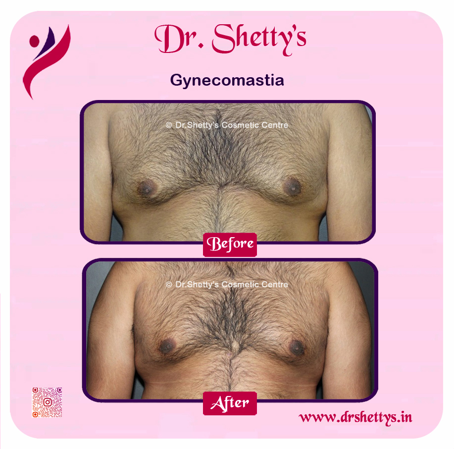Gynecomastia Surgery Male Breast Reduction 44