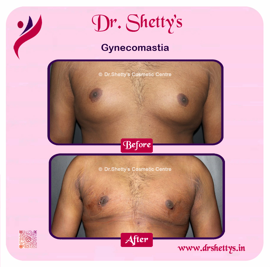 Gynecomastia Surgery Male Breast Reduction 45