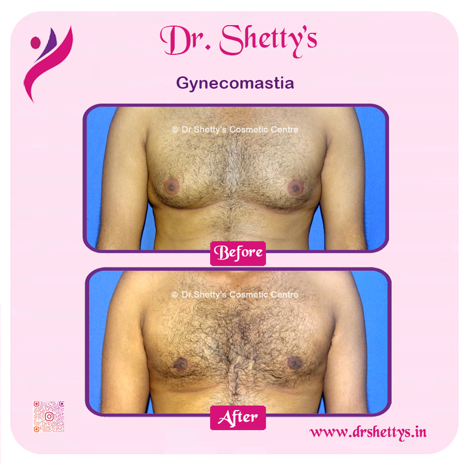 Gynecomastia Surgery Male Breast Reduction 5