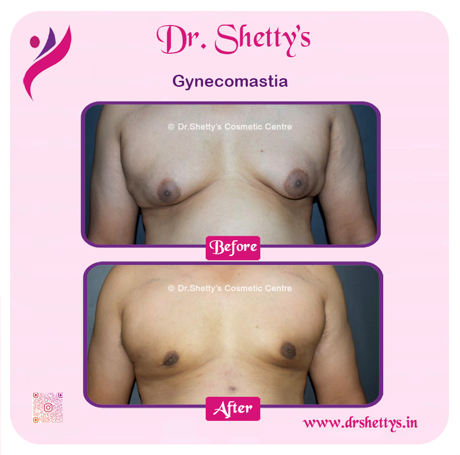 Gynecomastia Surgery Male Breast Reduction 6