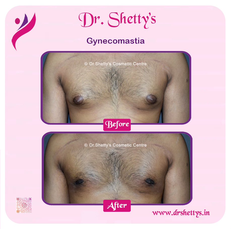 Gynecomastia Surgery Male Breast Reduction 7