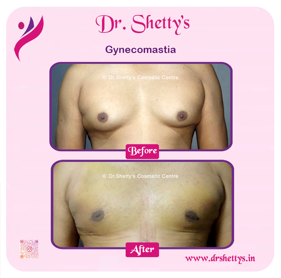 Gynecomastia Surgery Male Breast Reduction 9