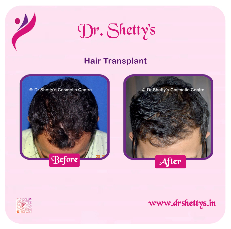 Hair Transplant 1