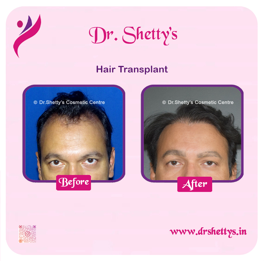 Hair Transplant 10