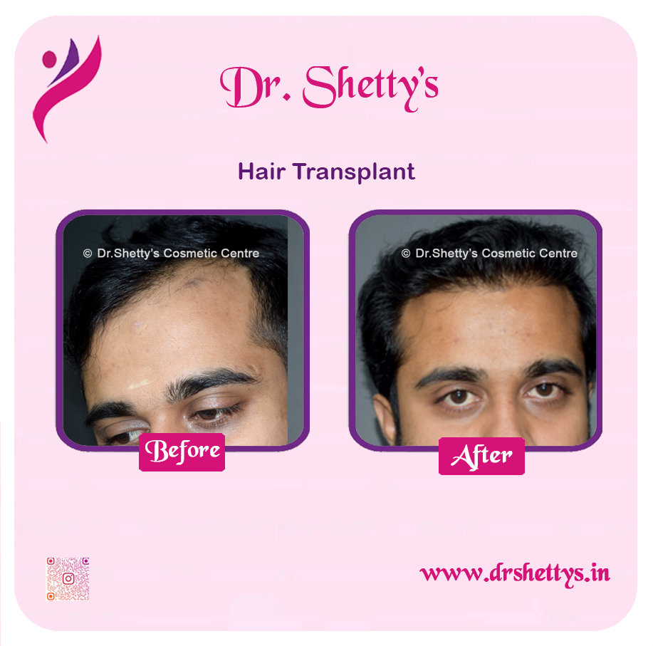 Hair Transplant 14