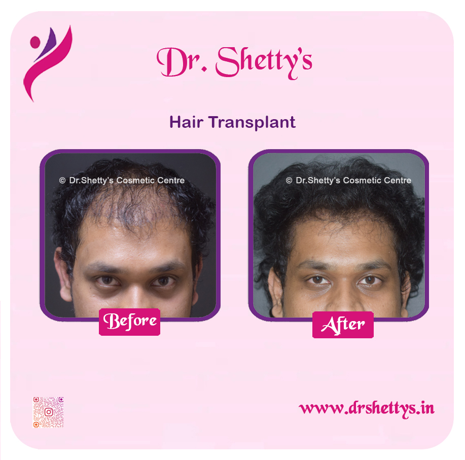 Hair Transplant 16