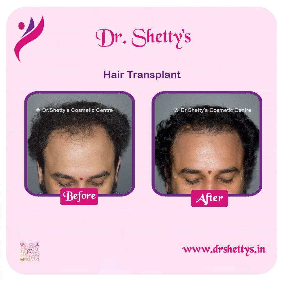 Hair Transplant 18