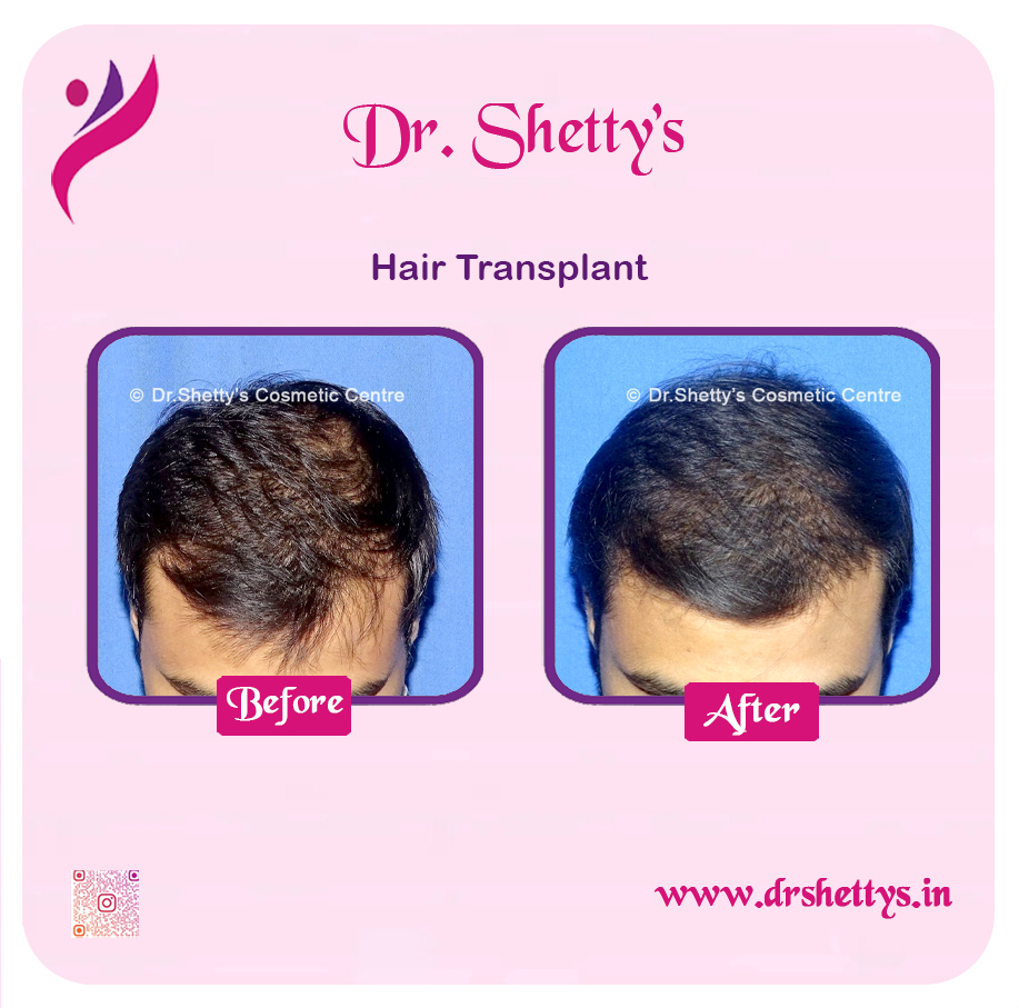 Hair Transplant 20