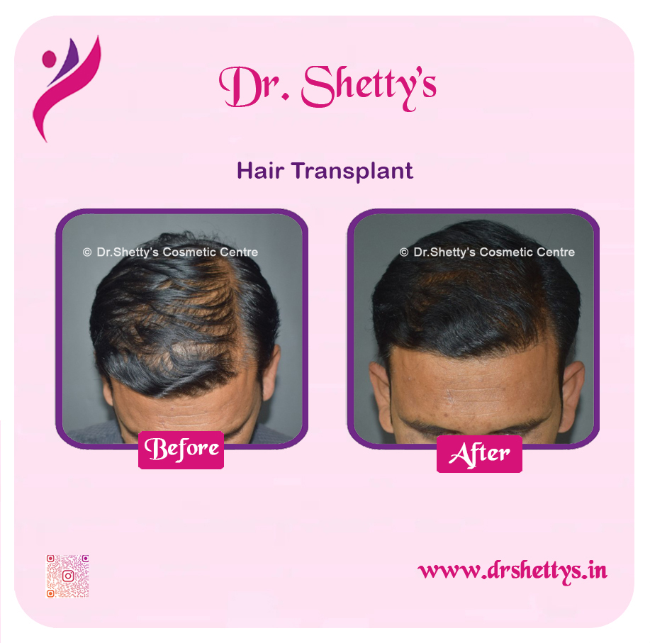 Hair Transplant 22