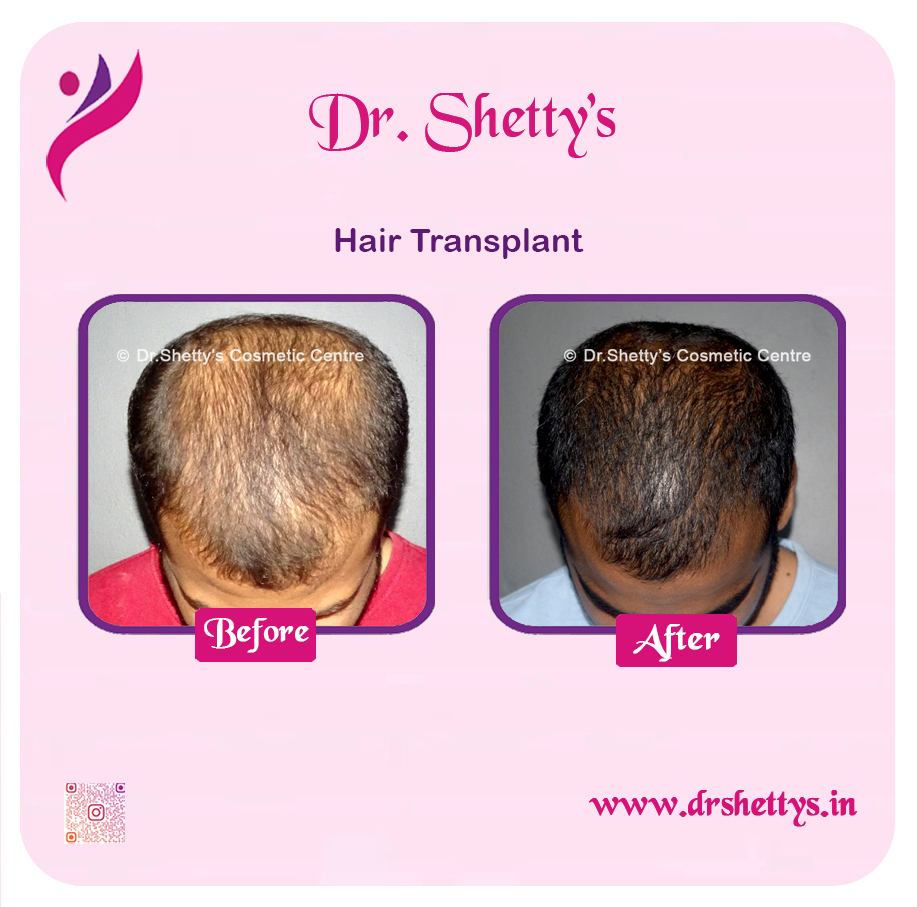Hair Transplant 26