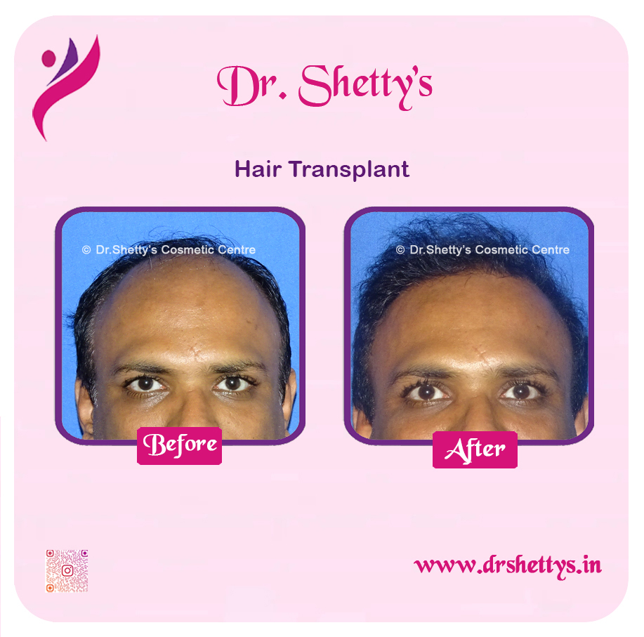 Hair Transplant 27