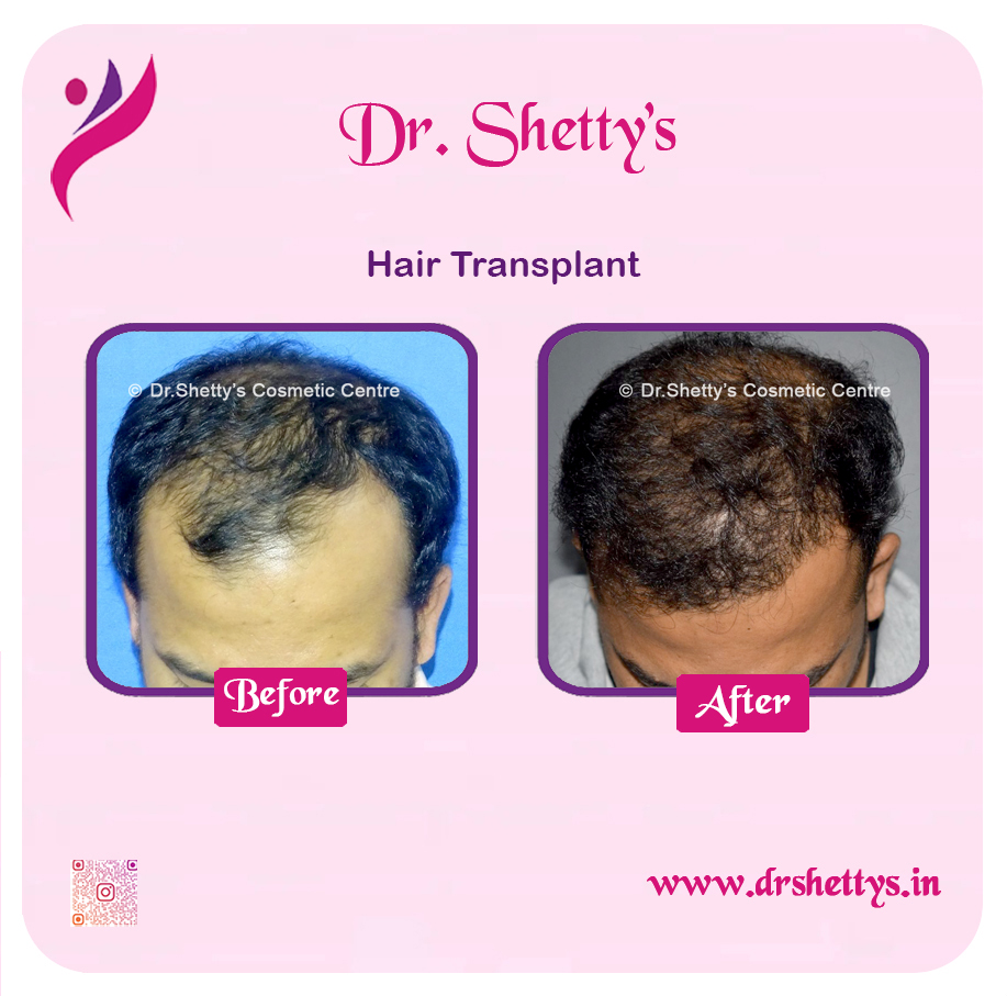 Hair Transplant 31