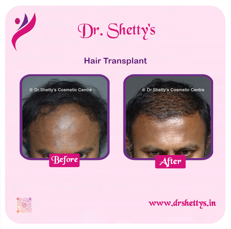 Hair Transplant 32