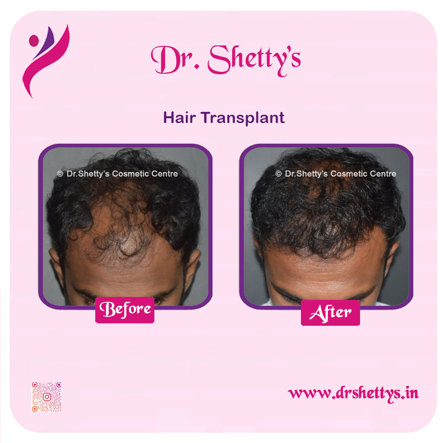 Hair Transplant 33
