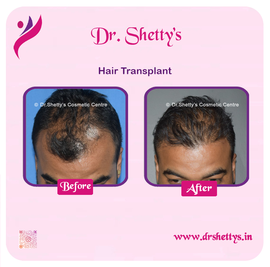 Hair Transplant 34