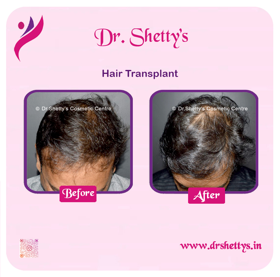 Hair Transplant 6