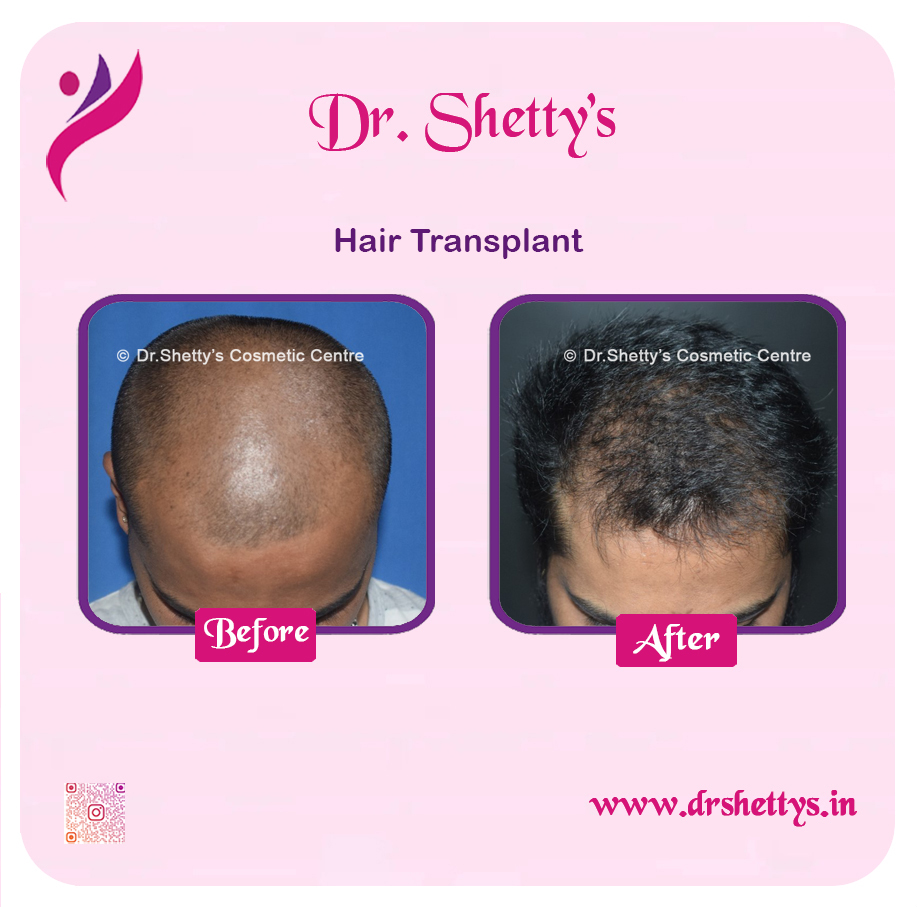 Hair Transplant 8