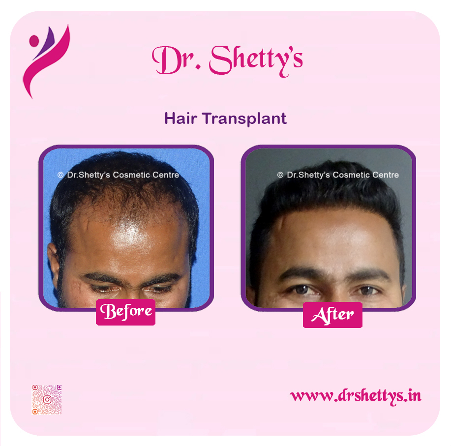 Hair Transplant 9