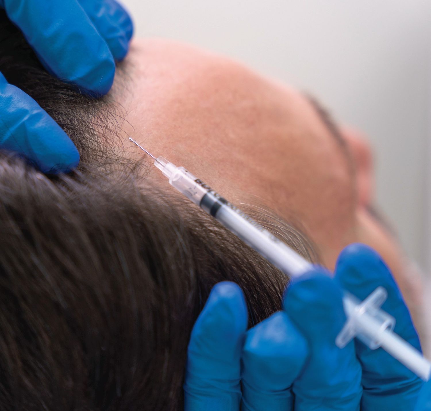 HairTransplant