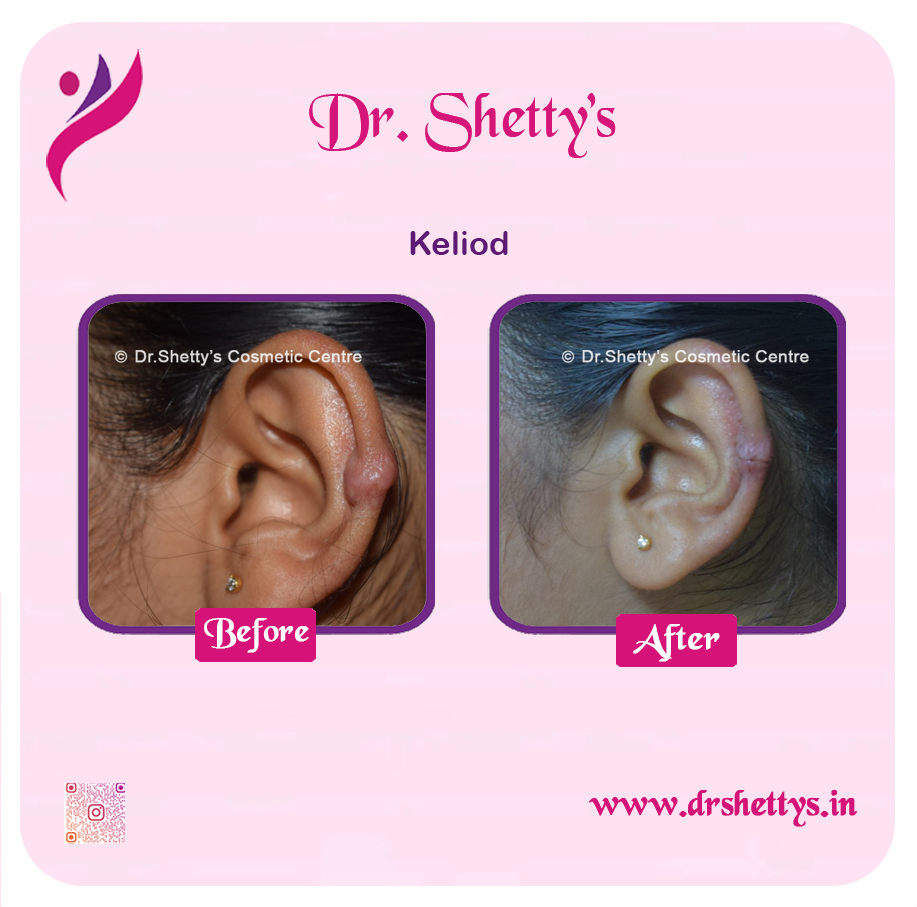 Keloid Treatment 1