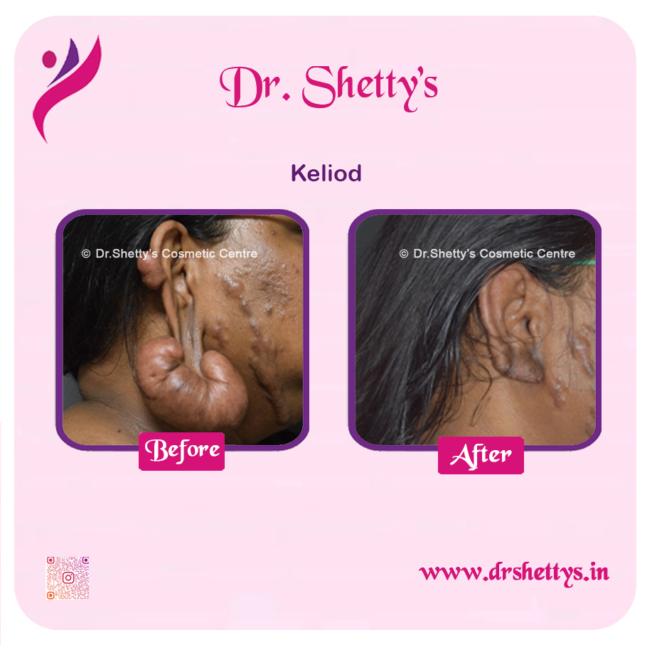 Keloid Treatment 10