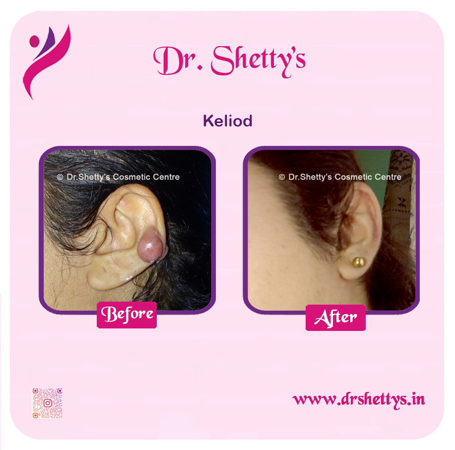 Keloid Treatment 11