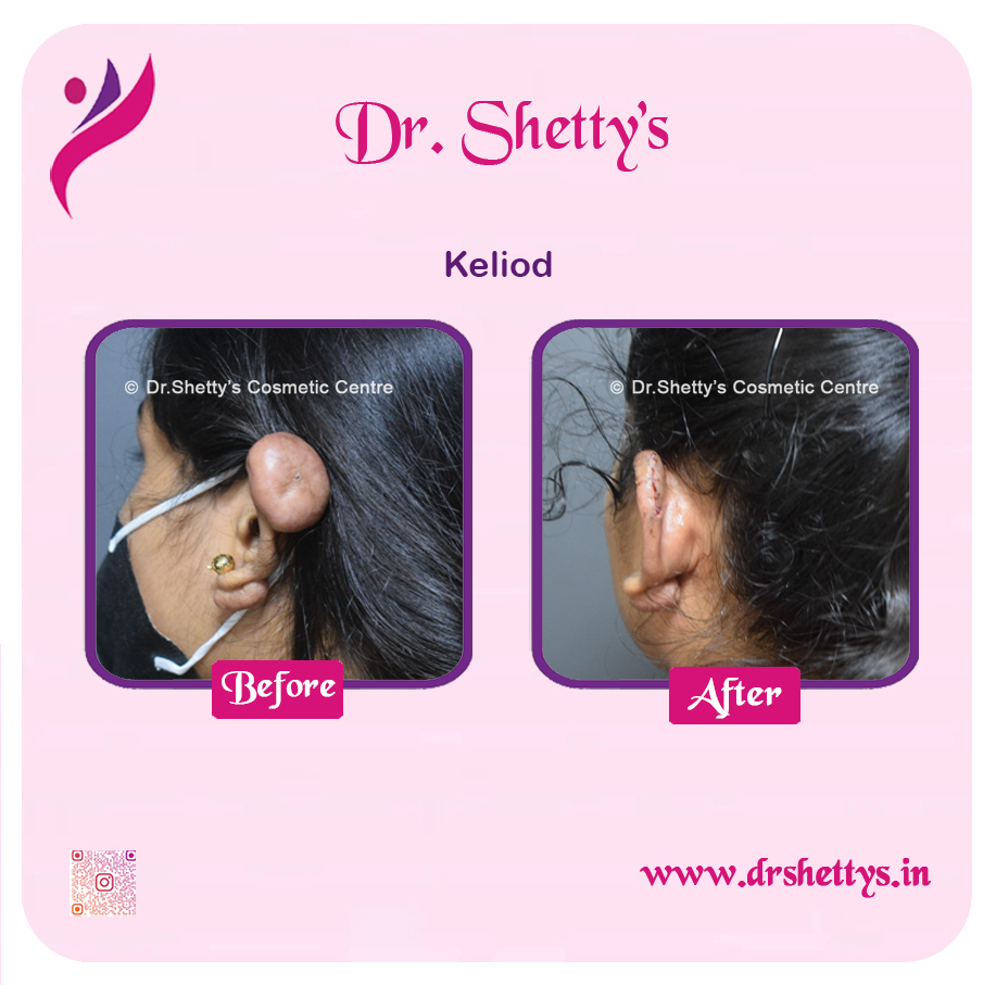 Keloid Treatment 12