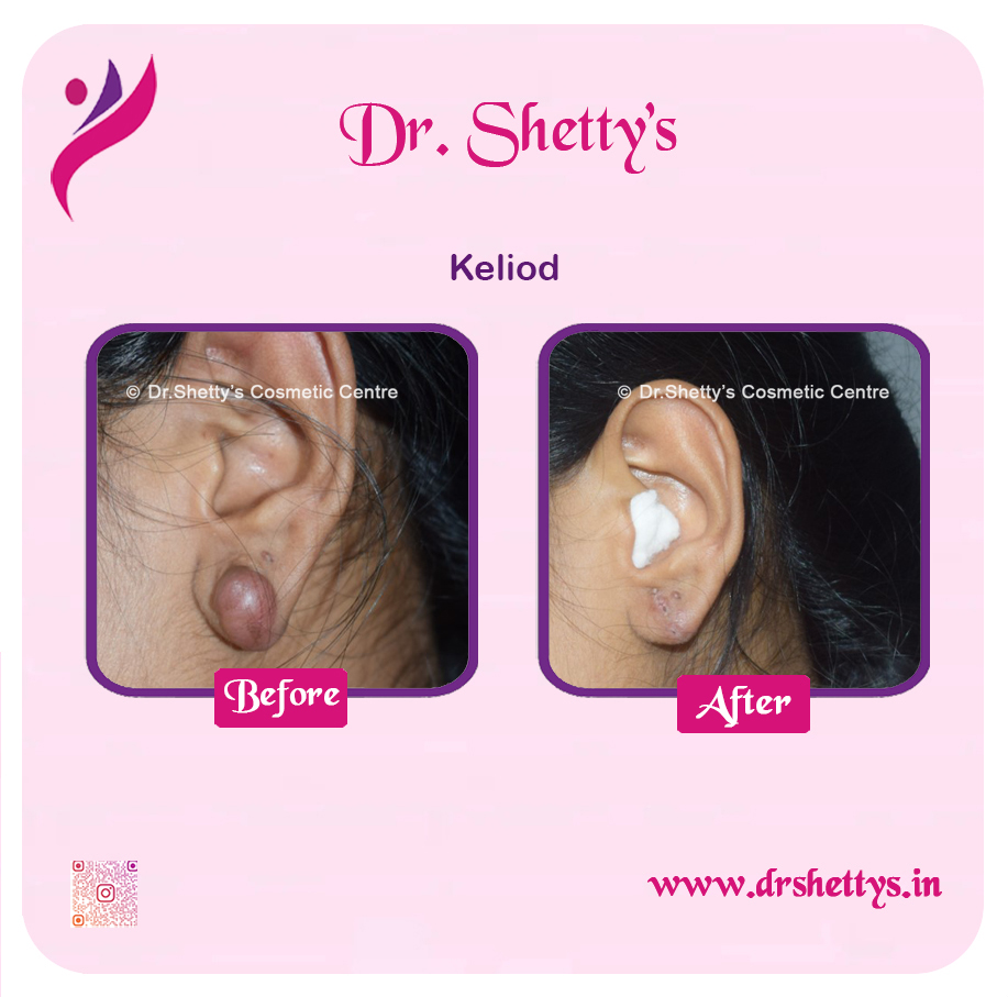 Keloid Treatment 13