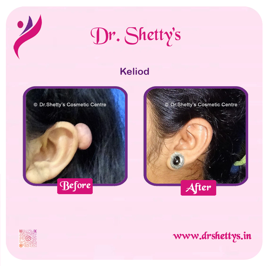 Keloid Treatment 14