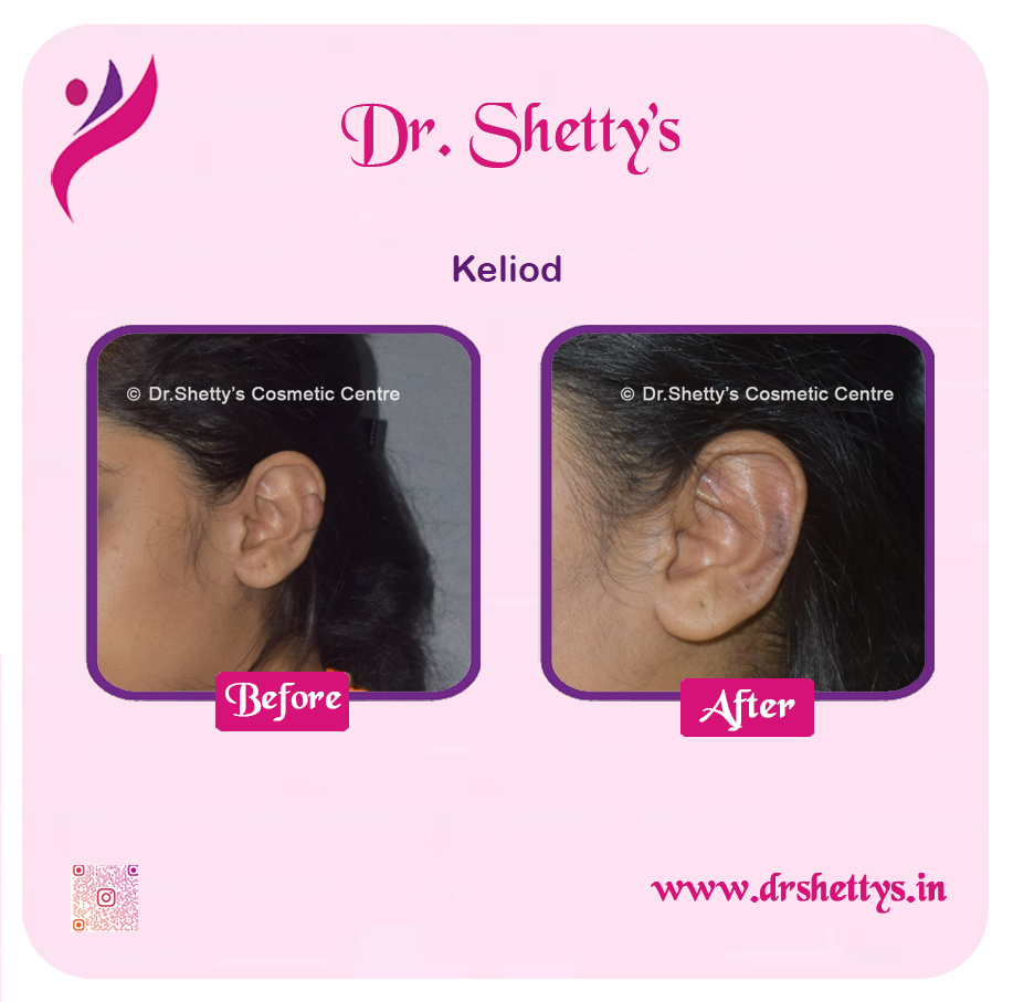 Keloid Treatment 15