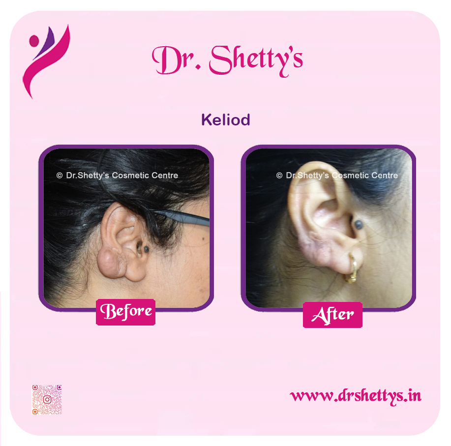 Keloid Treatment 16