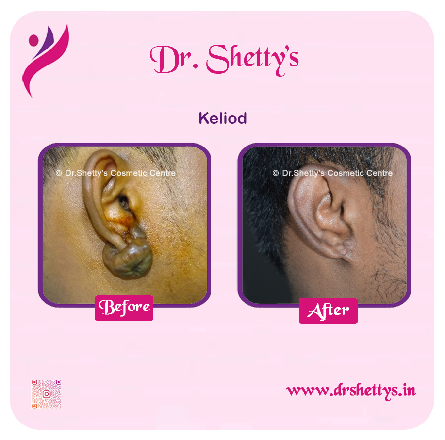 Keloid Treatment 17