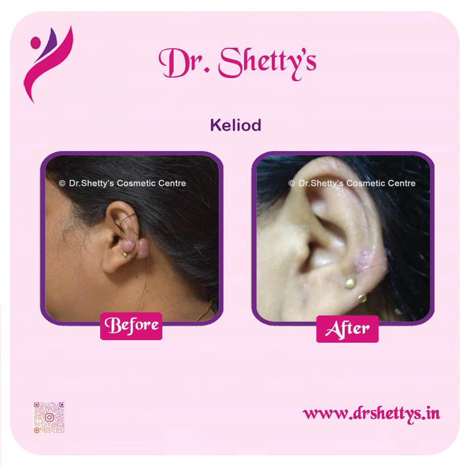 Keloid Treatment 18