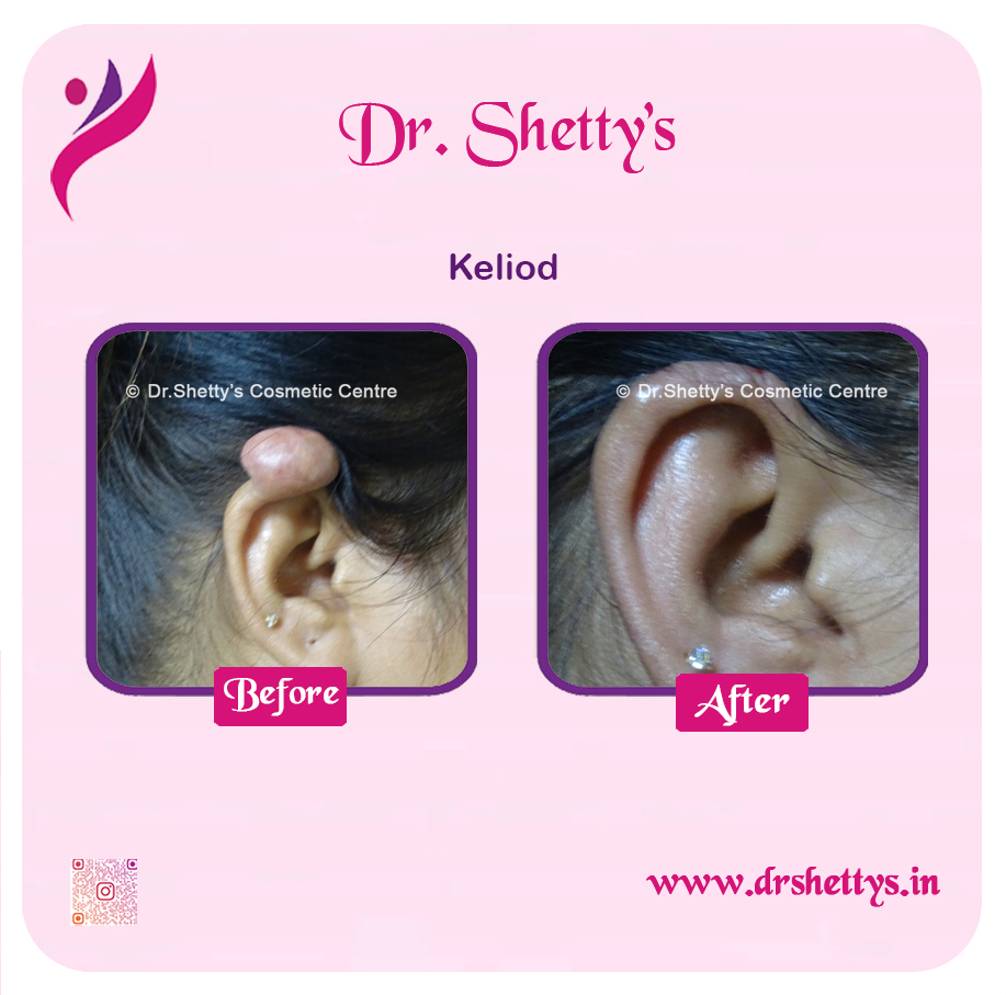 Keloid Treatment 19