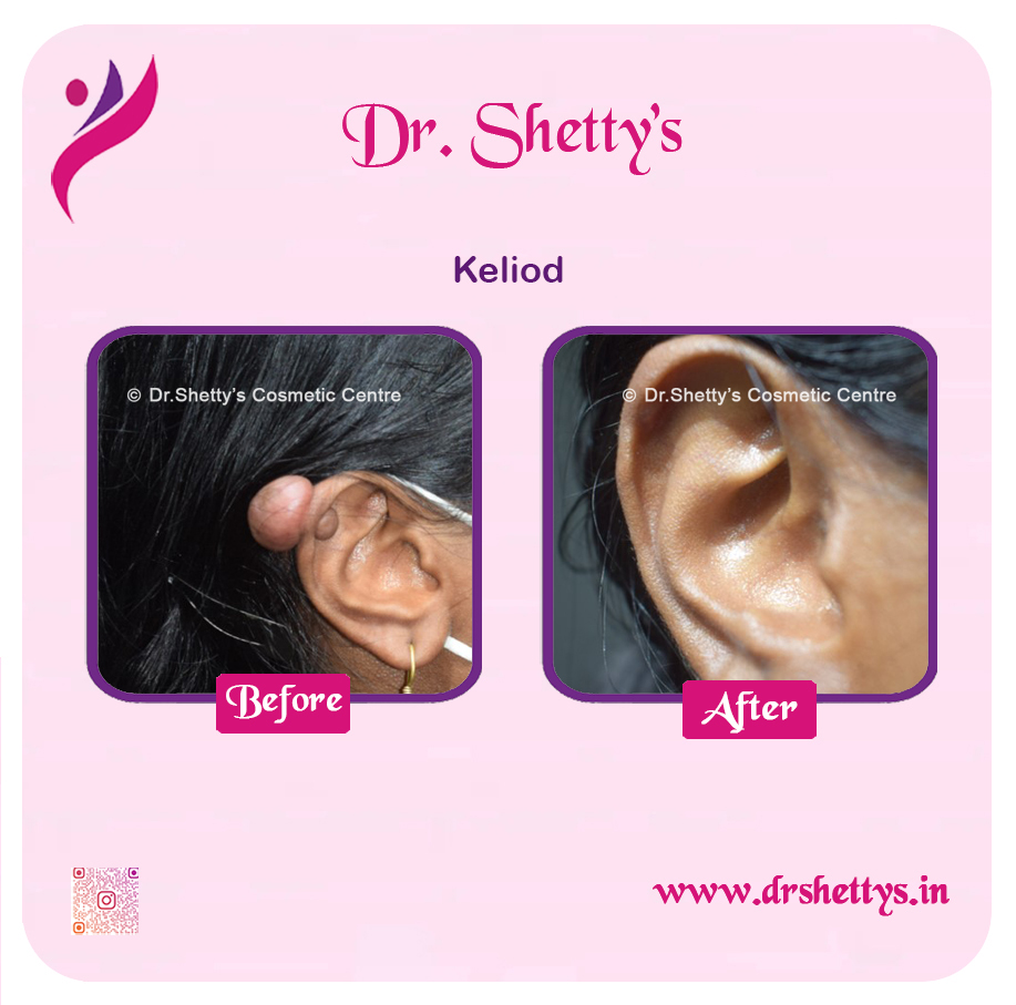 Keloid Treatment 2