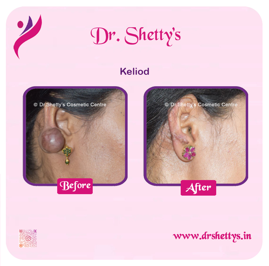 Keloid Treatment 20