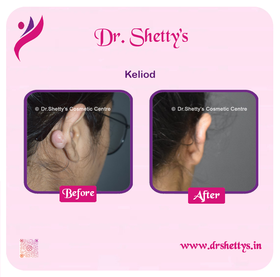 Keloid Treatment 3