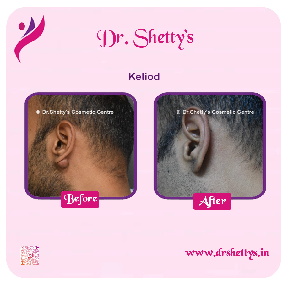 Keloid Treatment 4