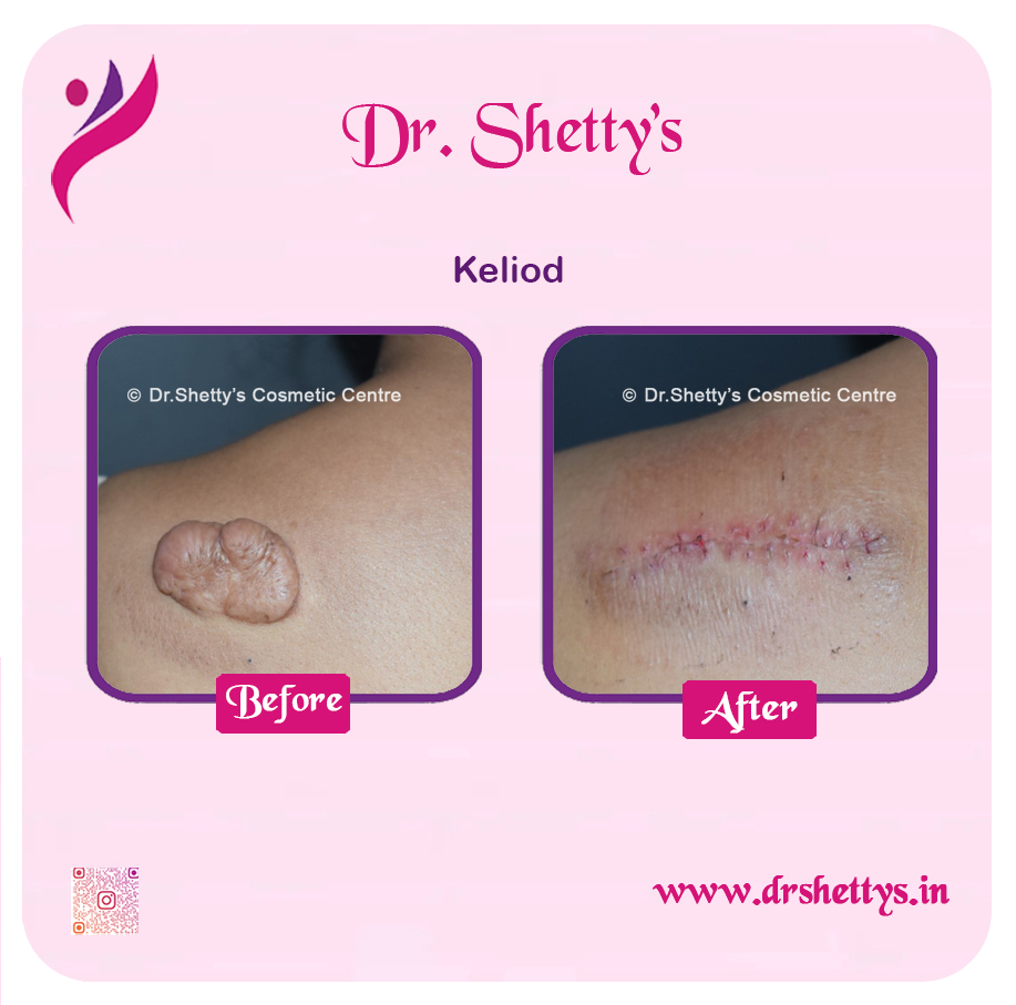 Keloid Treatment 6