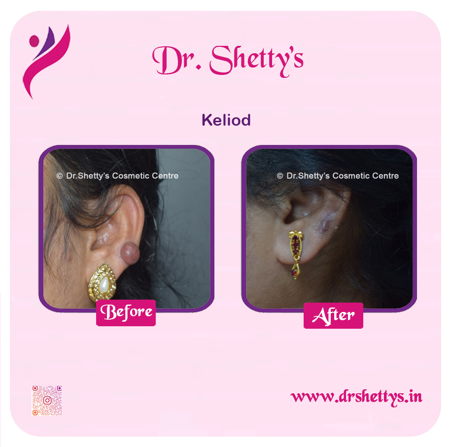Keloid Treatment 7