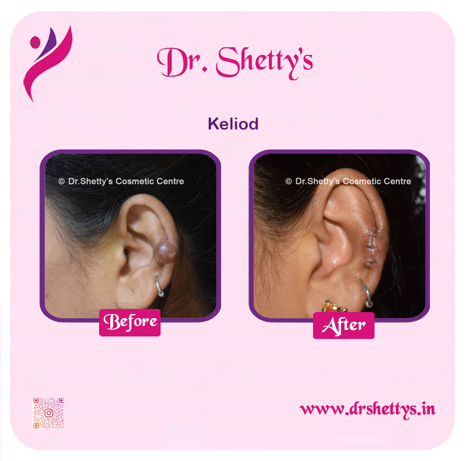 Keloid Treatment 8