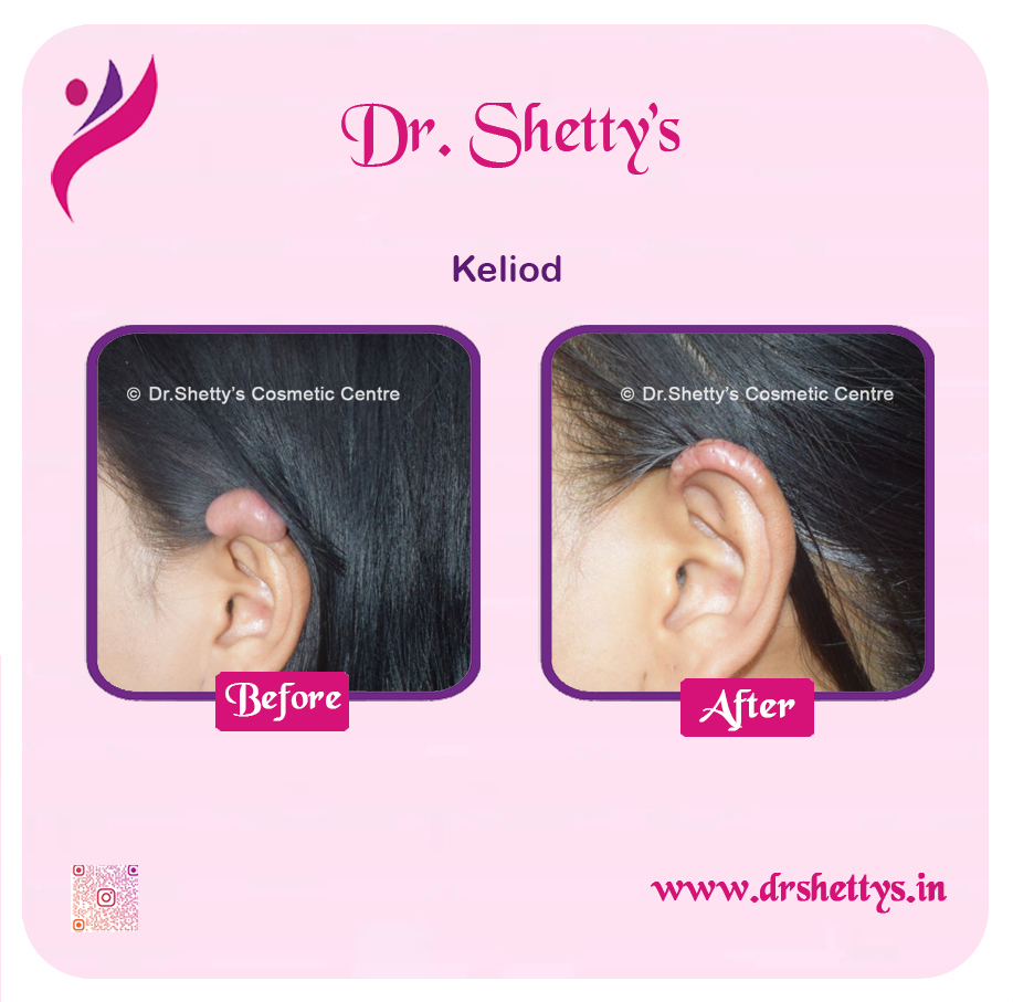 Keloid Treatment 9